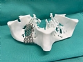 3D-Printed Implant Saves 59-Year-Old’s Sight
